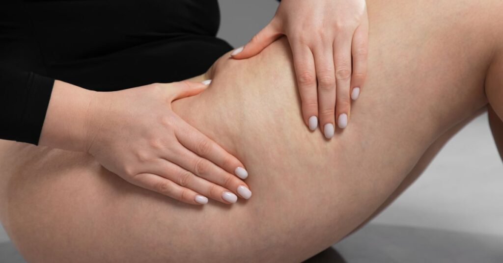 Lymphedema & Cellulite: When Fluid Retention Is More Than an Aesthetic Concern