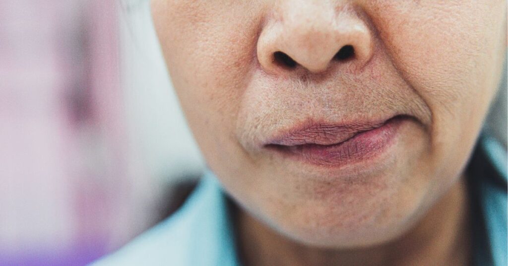 Facial Paresis Rehabilitation Nasos Tsivgoulis